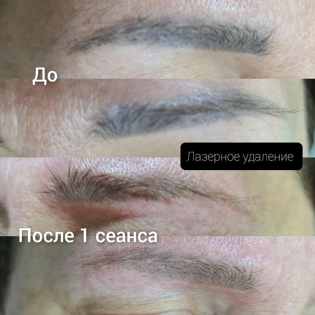 Удаление татуажа бровей, работа 2